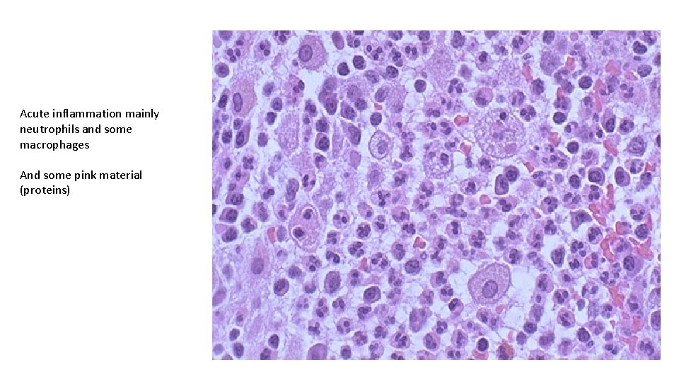 Acute inflammation mainly neutrophils and some macrophages And some pink material (proteins) 