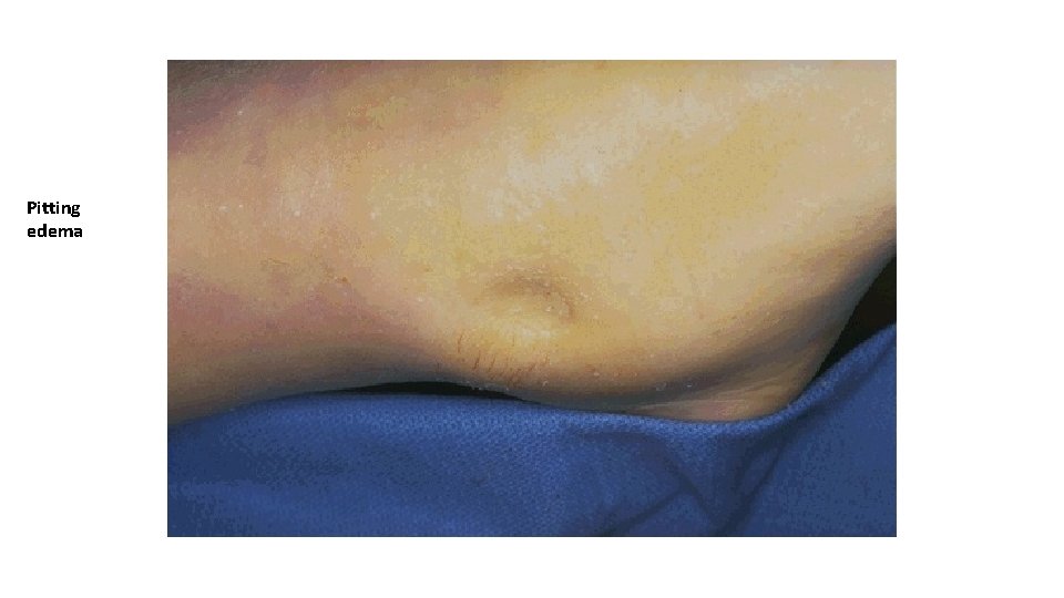 Pitting edema 