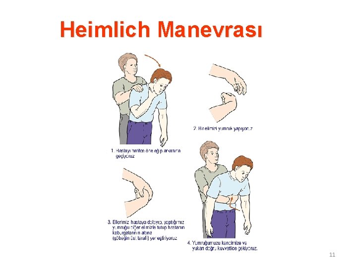 Heimlich Manevrası 11 