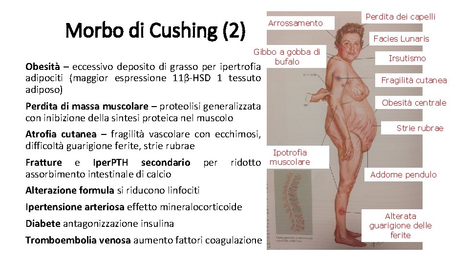 Morbo di Cushing (2) Arrossamento Facies Lunaris Gibbo a gobba di bufalo Obesità –