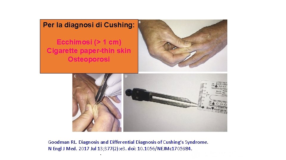 Diagnosis of Cushing’s Syndrome Measurement of Skinfold Thickness. Per la diagnosi di Cushing: Ecchimosi