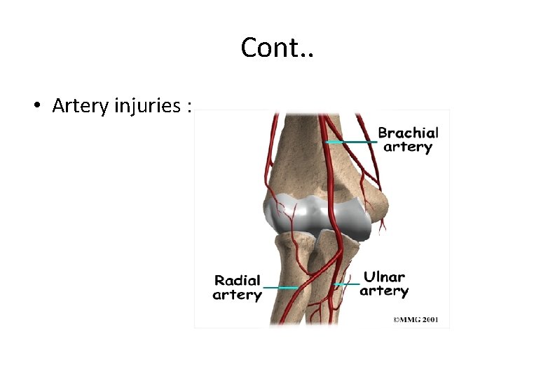 Cont. . • Artery injuries : 