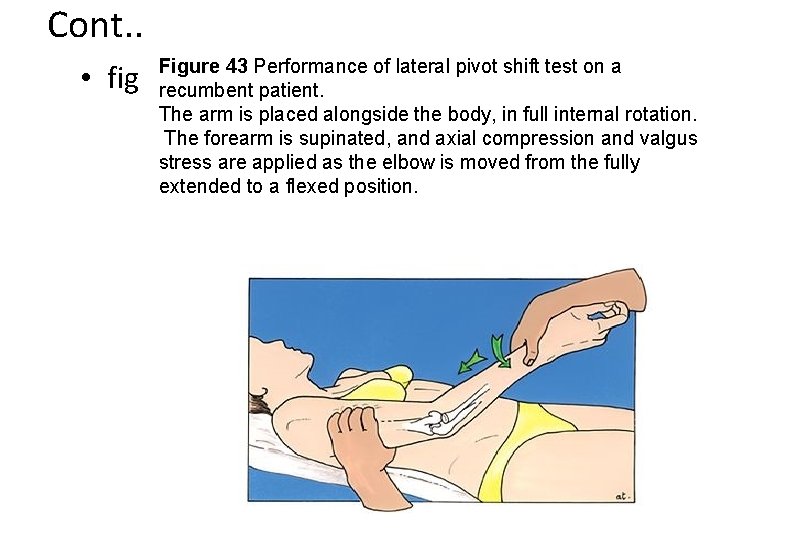 Cont. . • fig Figure 43 Performance of lateral pivot shift test on a