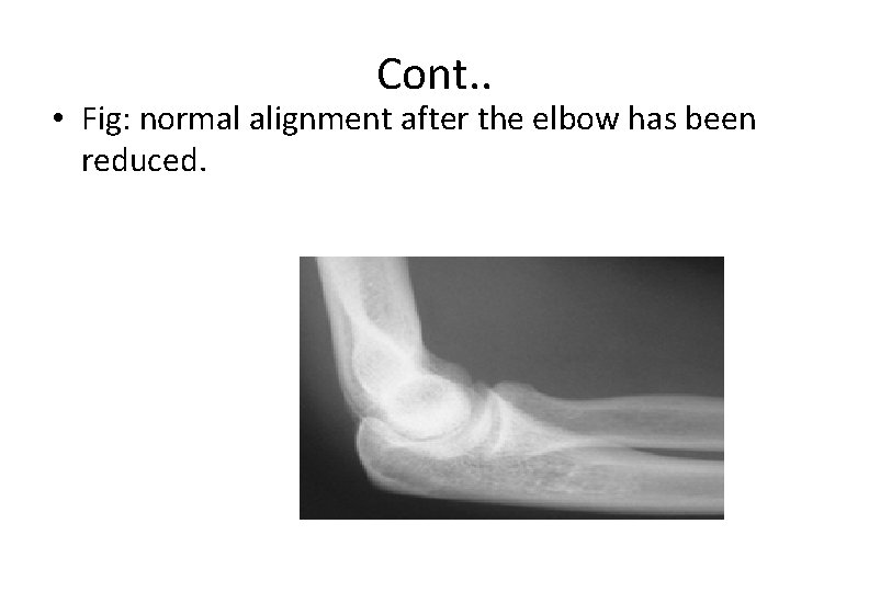 Cont. . • Fig: normal alignment after the elbow has been reduced. 