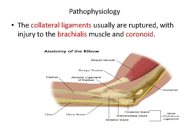 Pathophysiology • The collateral ligaments usually are ruptured, with injury to the brachialis muscle