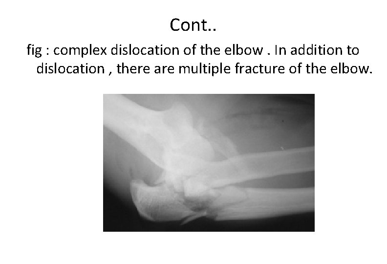 Cont. . fig : complex dislocation of the elbow. In addition to dislocation ,