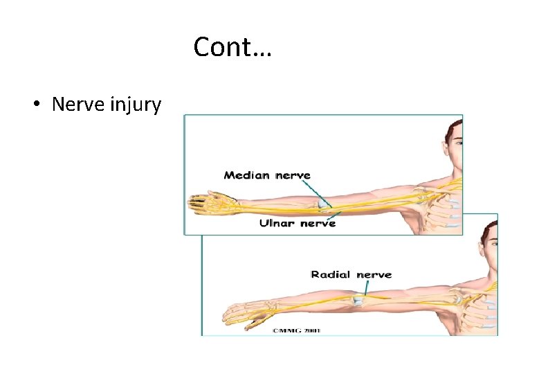 Cont… • Nerve injury 