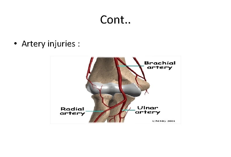 Cont. . • Artery injuries : 