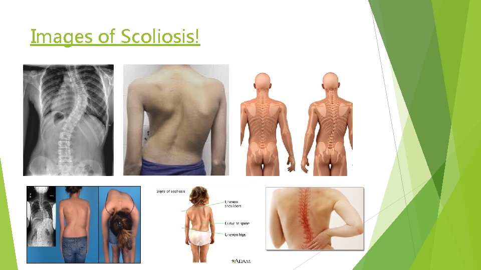Images of Scoliosis! 