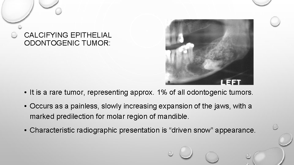 CALCIFYING EPITHELIAL ODONTOGENIC TUMOR: • It is a rare tumor, representing approx. 1% of