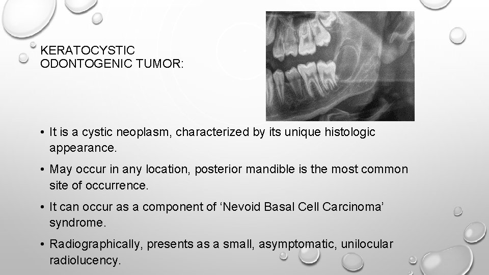 KERATOCYSTIC ODONTOGENIC TUMOR: • It is a cystic neoplasm, characterized by its unique histologic