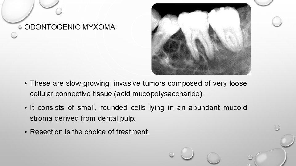 ODONTOGENIC MYXOMA: • These are slow-growing, invasive tumors composed of very loose cellular connective