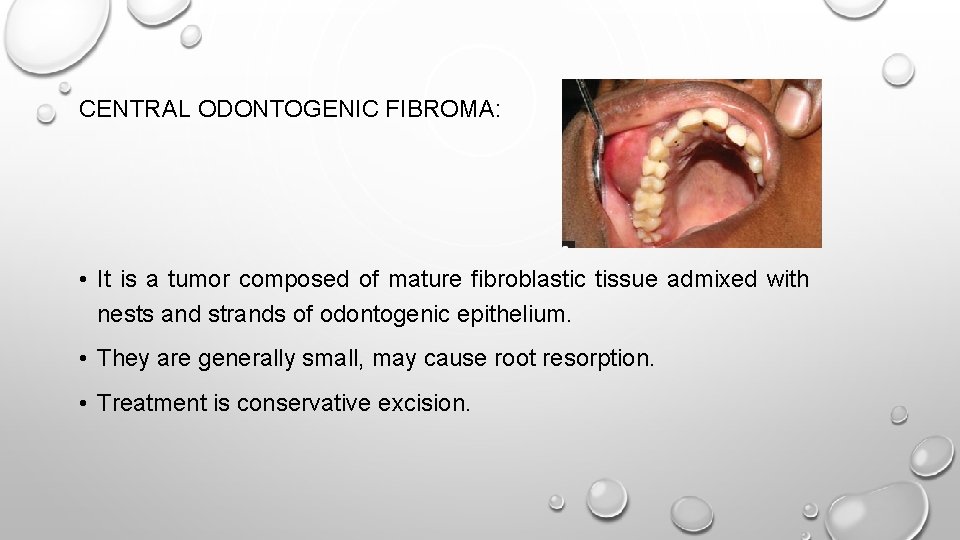 CENTRAL ODONTOGENIC FIBROMA: • It is a tumor composed of mature fibroblastic tissue admixed