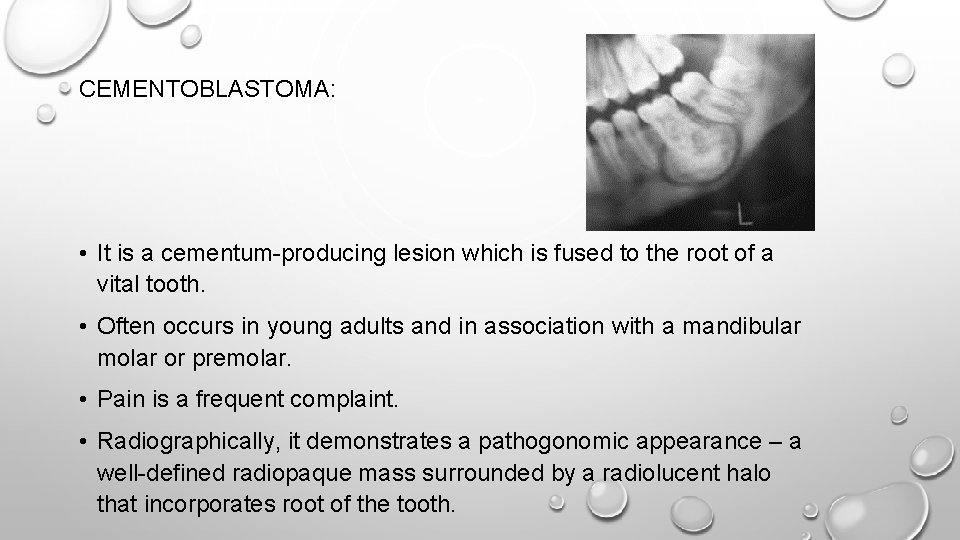 CEMENTOBLASTOMA: • It is a cementum-producing lesion which is fused to the root of