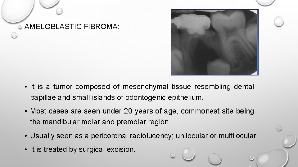 AMELOBLASTIC FIBROMA: • It is a tumor composed of mesenchymal tissue resembling dental papillae