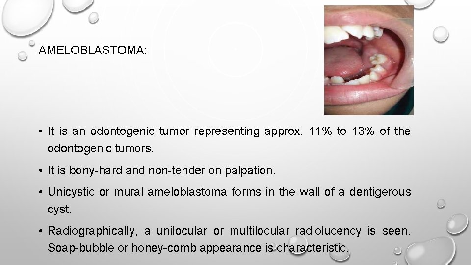 AMELOBLASTOMA: • It is an odontogenic tumor representing approx. 11% to 13% of the