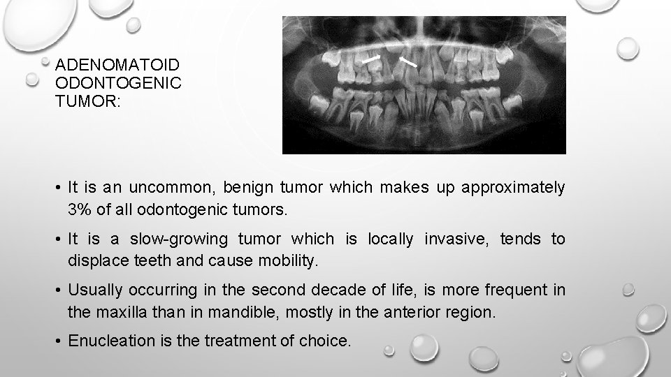 ADENOMATOID ODONTOGENIC TUMOR: • It is an uncommon, benign tumor which makes up approximately