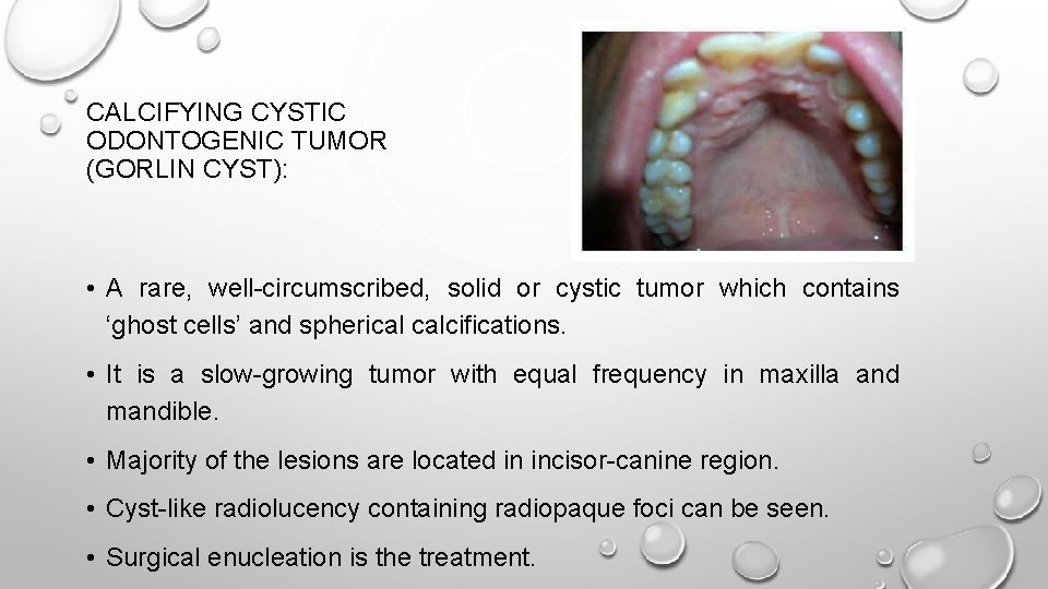 CALCIFYING CYSTIC ODONTOGENIC TUMOR (GORLIN CYST): • A rare, well-circumscribed, solid or cystic tumor