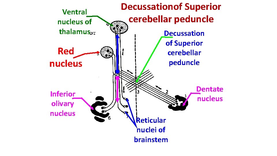 Ventral nucleus of thalamus Red nucleus Inferior olivary nucleus Decussationof Superior cerebellar peduncle Decussation