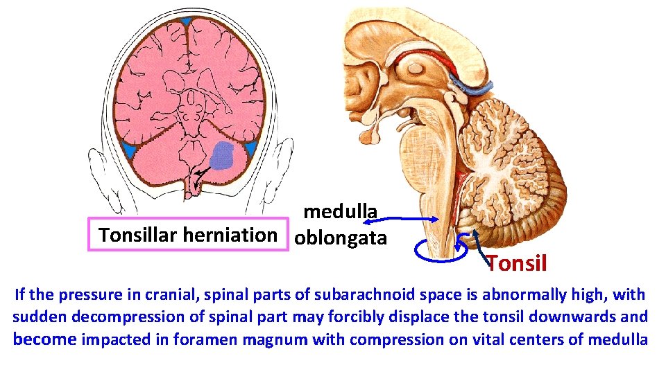 medulla Tonsillar herniation oblongata Tonsil If the pressure in cranial, spinal parts of subarachnoid