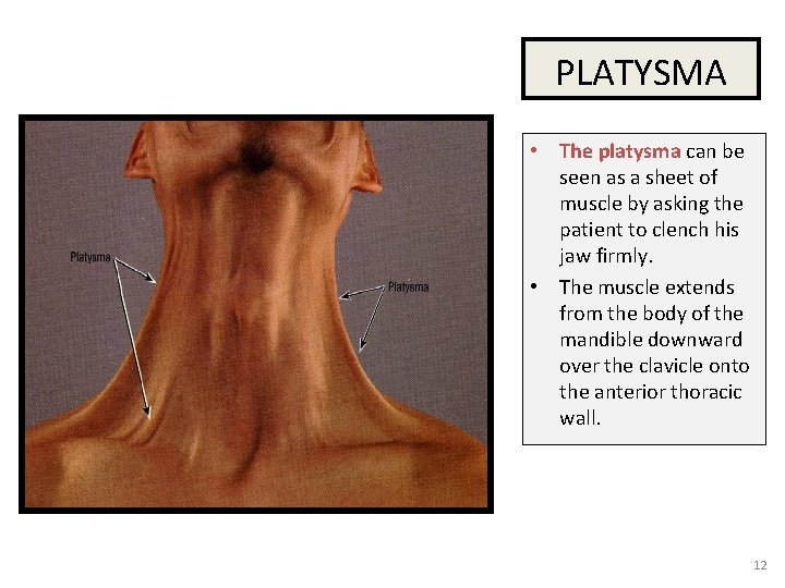 PLATYSMA • The platysma can be seen as a sheet of muscle by asking