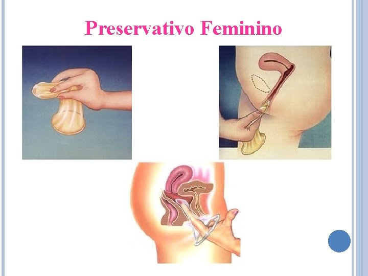 Preservativo Feminino 