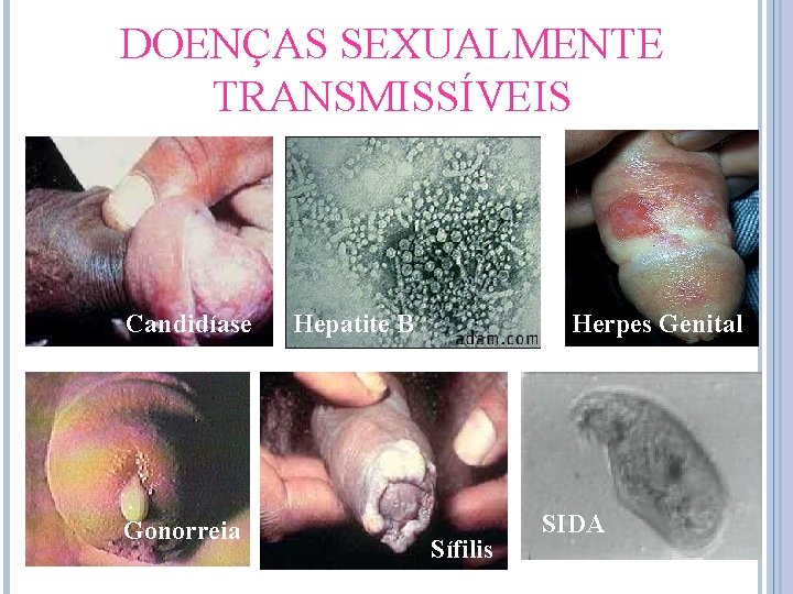 DOENÇAS SEXUALMENTE TRANSMISSÍVEIS Candidíase Gonorreia Hepatite B Herpes Genital Sífilis SIDA 