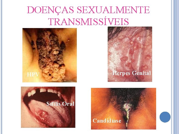 DOENÇAS SEXUALMENTE TRANSMISSÍVEIS Herpes Genital HPV Sífilis Oral Gonorreia Candidíase 