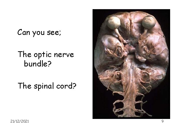 Can you see; The optic nerve bundle? The spinal cord? 21/12/2021 9 