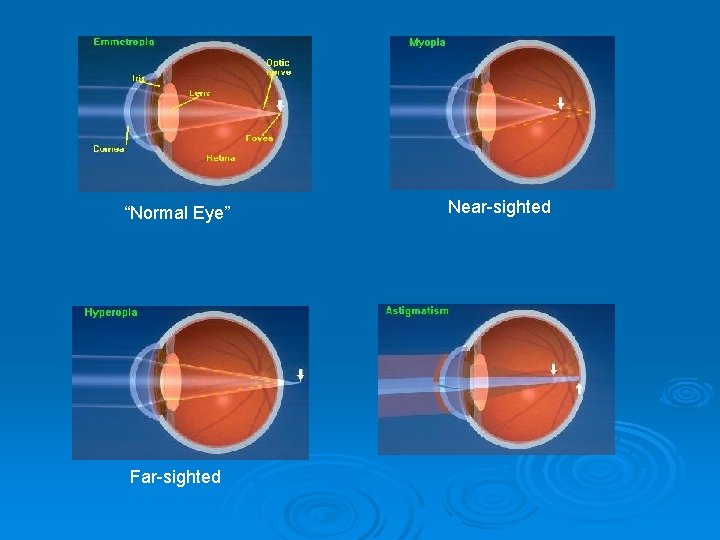 “Normal Eye” Far-sighted Near-sighted 