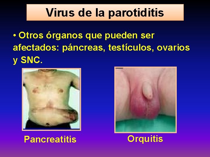 Virus de la parotiditis • Otros órganos que pueden ser afectados: páncreas, testículos, ovarios