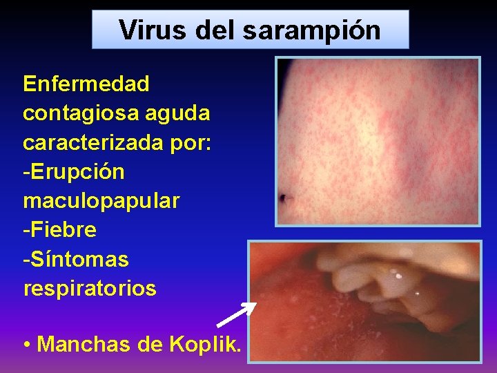 Virus del sarampión Enfermedad contagiosa aguda caracterizada por: -Erupción maculopapular -Fiebre -Síntomas respiratorios •