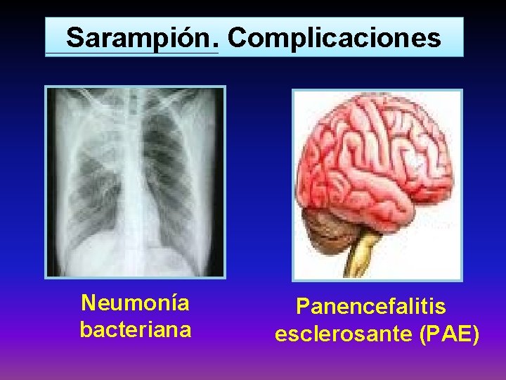 Sarampión. Complicaciones Neumonía bacteriana Panencefalitis esclerosante (PAE) 