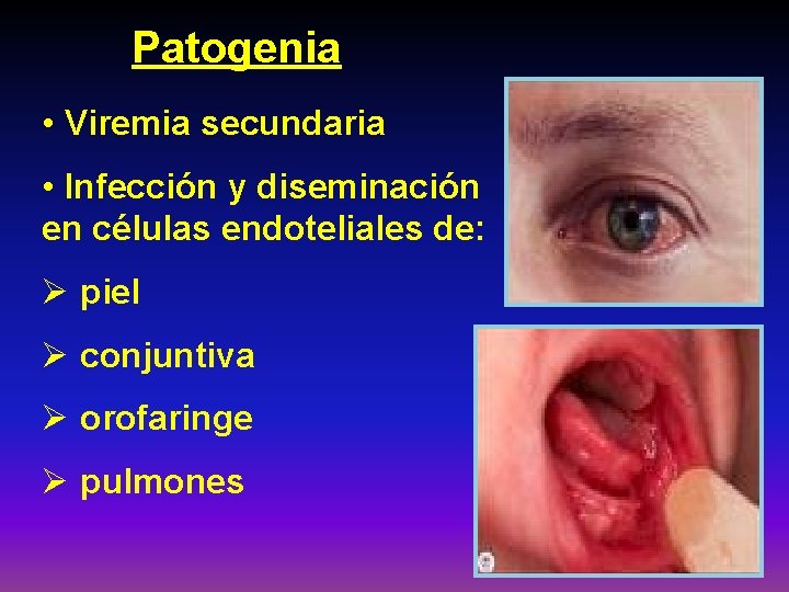 Patogenia • Viremia secundaria • Infección y diseminación en células endoteliales de: Ø piel