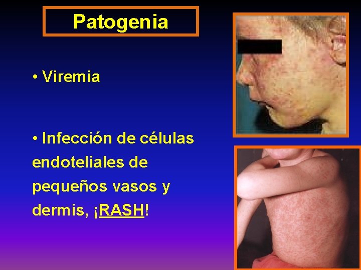 Patogenia • Viremia • Infección de células endoteliales de pequeños vasos y dermis, ¡RASH!