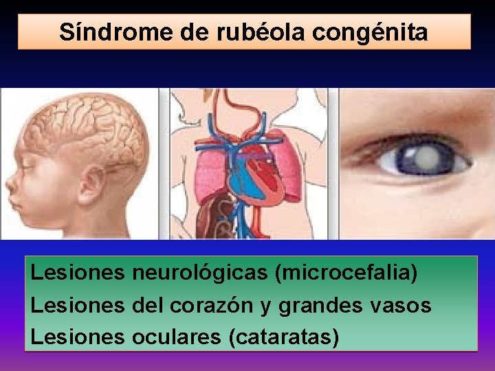 Síndrome de rubéola congénita Lesiones neurológicas (microcefalia) Lesiones del corazón y grandes vasos Lesiones