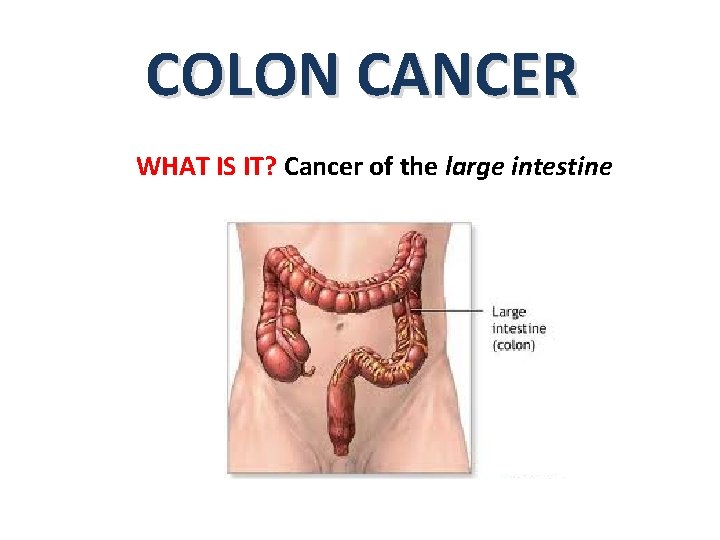 COLON CANCER WHAT IS IT? Cancer of the large intestine 