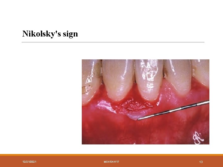 Nikolsky's sign 12/21/2021 MOKSHA'17 13 