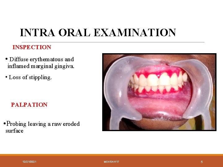 INTRA ORAL EXAMINATION INSPECTION • Diffuse erythematous and inflamed marginal gingiva. • Loss of