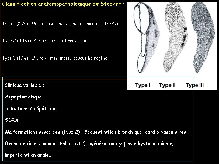 Classification anatomopathologique de Stocker : Type 1 (50%) : Un ou plusieurs kystes de