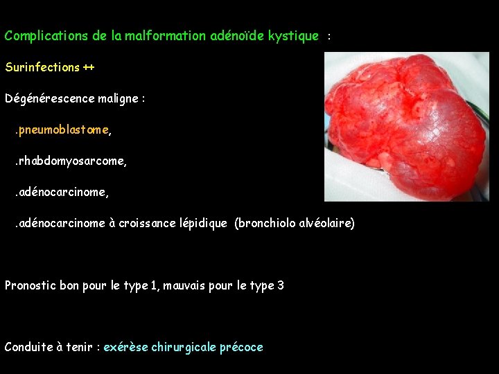 Complications de la malformation adénoïde kystique : Surinfections ++ Dégénérescence maligne : . pneumoblastome,