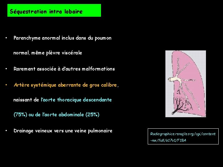 Séquestration intra lobaire • Parenchyme anormal inclus dans du poumon normal, même plèvre viscérale