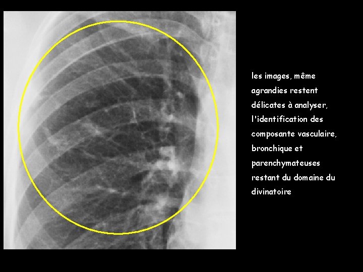 les images, même agrandies restent délicates à analyser, l'identification des composante vasculaire, bronchique et