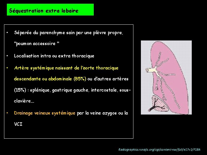 Séquestration extra lobaire • Séparée du parenchyme sain par une plèvre propre, "poumon accessoire