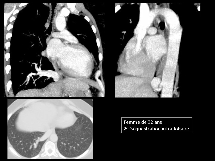 Femme de 32 ans Ø Séquestration intra-lobaire 
