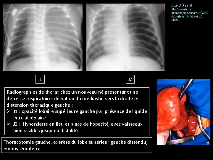 Dyon J-F et Al. Malformations bronchopulmonaires. EMC, Pédiatrie , 4 -063 -8 -10, 2007