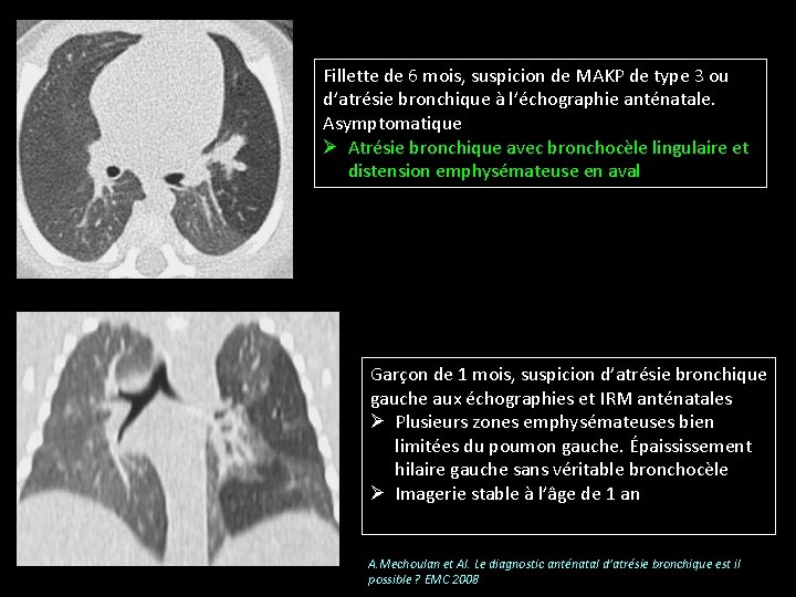 Fillette de 6 mois, suspicion de MAKP de type 3 ou d’atrésie bronchique à