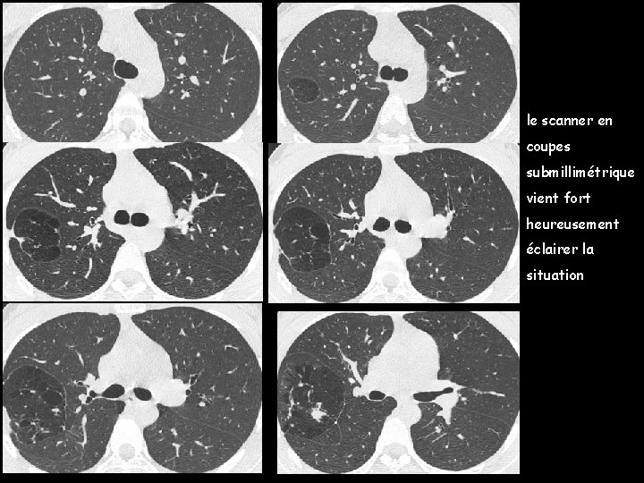 le scanner en coupes submillimétrique vient fort heureusement éclairer la situation 