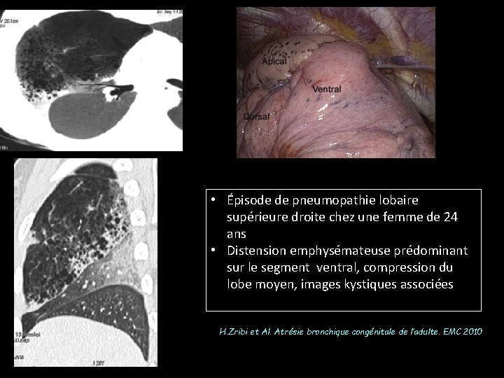  • Épisode de pneumopathie lobaire supérieure droite chez une femme de 24 ans