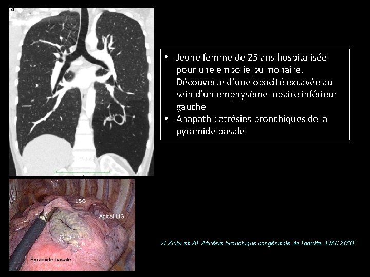  • Jeune femme de 25 ans hospitalisée pour une embolie pulmonaire. Découverte d’une